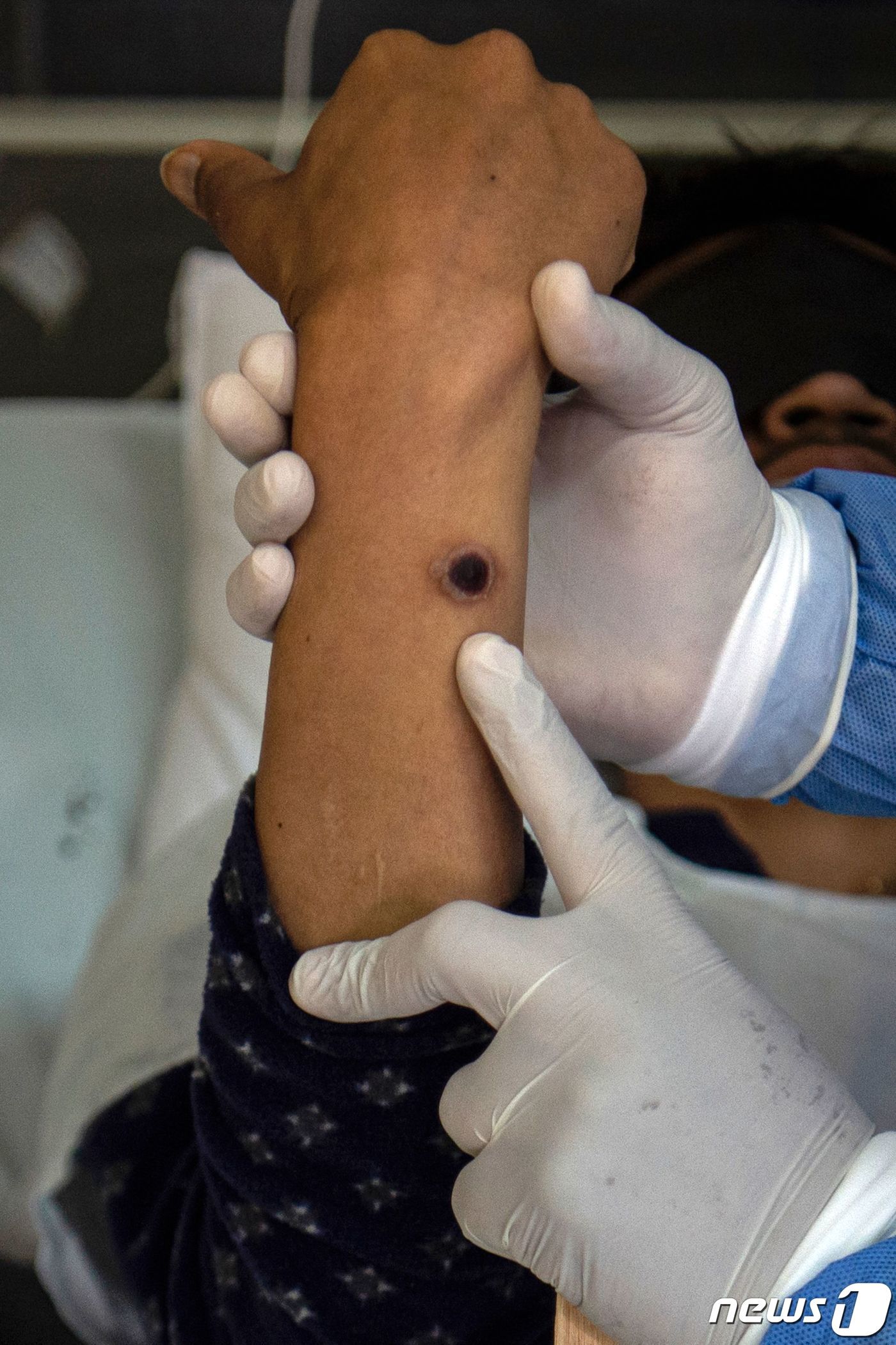 본문 이미지 - 16일&#40;현지시간&#41; 페루 리마 아르조비스포 로아이자 병원에서 의사가 원숭이두창 감염 환자를 진료하고 있다. 페루의 원숭이두창 신규 확진자는 15일 기준 122명으로 누적 775명으로 집계됐다. ⓒ AFP=뉴스1 ⓒ News1 손승환 기자