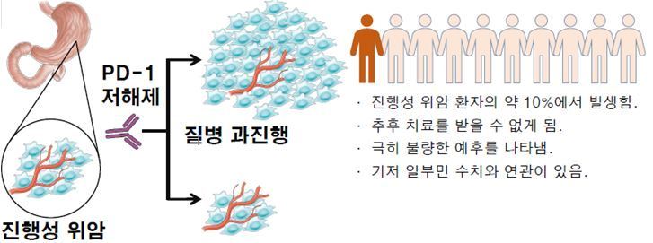본문 이미지 - 진행성 위암 환자에서 면역관문억제제(PD-1 저해제) 투여에 따른 결과ⓒ 세브란스병원