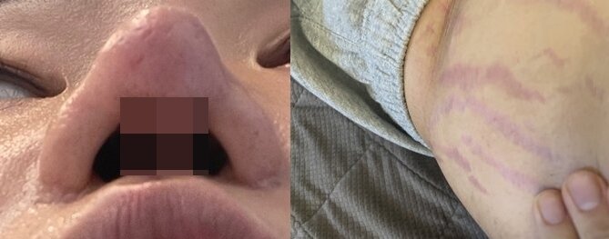 본문 이미지 - 강씨의 현재 코 모양과 장기간의 스테로이드제 치료로 생긴 흉살. ⓒ 뉴스1