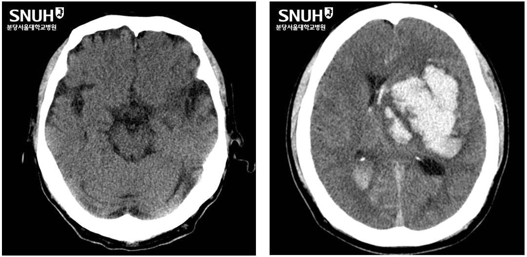 본문 이미지 - 정상 환자의 CT(좌), 뇌출혈 환자 CT(우). (분당서울대병원 제공)