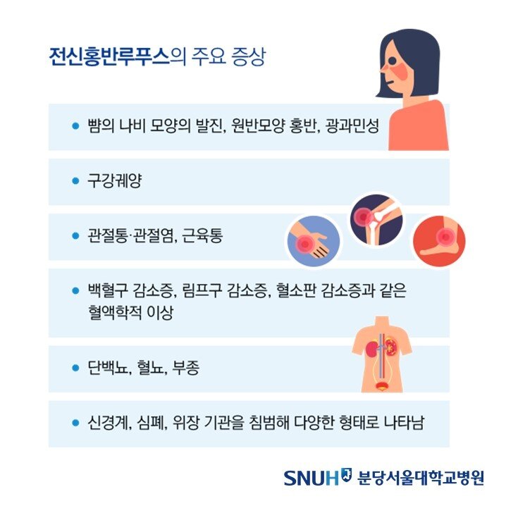 본문 이미지 - 전신홍반루푸스의 주요 증상. (분당서울대병원 제공)
