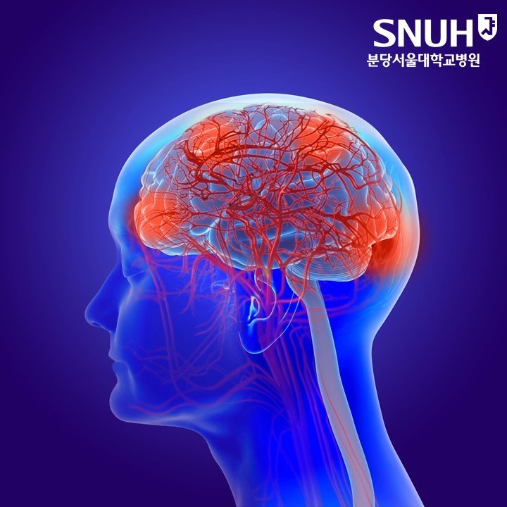 본문 이미지 - (분당서울대병원 제공)