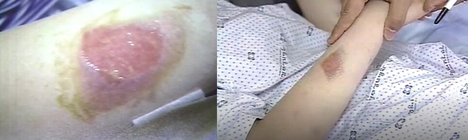 본문 이미지 - 2006년 학폭 피해자 정양이 고데기 열로 입은 상처. (MBC 갈무리)