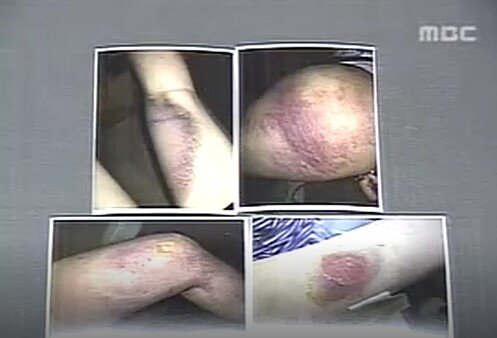 본문 이미지 - 2006년 당시 가해 학생들의 폭행으로 온몸에 피멍이 든 정양의 모습. (MBC 갈무리)