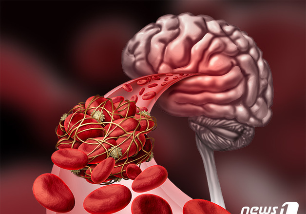 심근경색 1년 내 사망 16.1%, 뇌졸중 19.8%…"발병 후 1년이 고비"