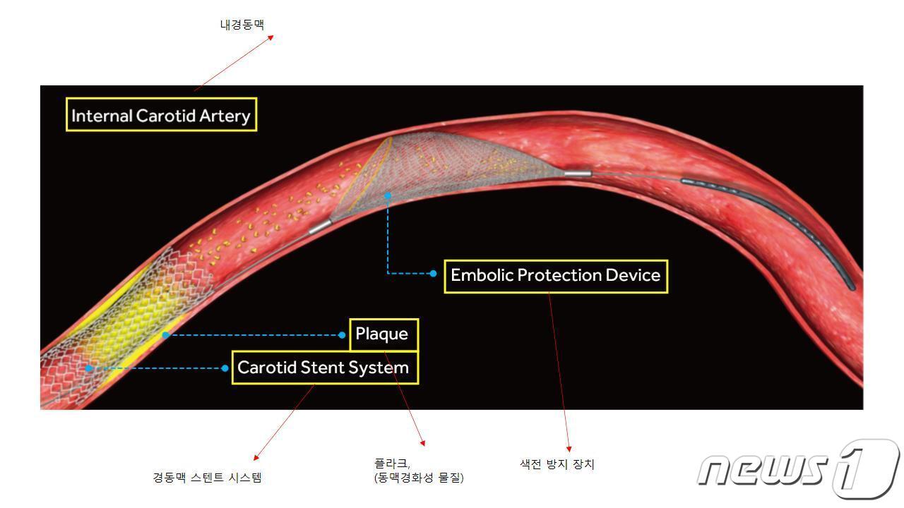 본문 이미지 - 경동맥 스텐트 삽입술