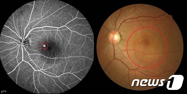 본문 이미지 - 중심장액성 맥락망막병증으로 누출점이 보이는 형광안저조영술 사진(왼쪽), 황반부 염증으로 인해 망막 아래에 물이 고여 있는 모습의 안저사진/(김안과병원 제공)