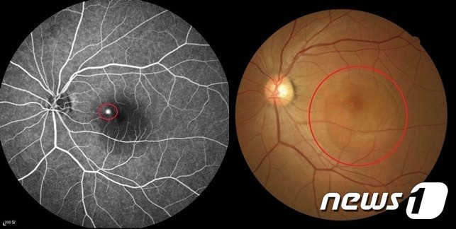 중심장액성 맥락망막병증으로 누출점이 보이는 형광안저조영술 사진&#40;왼쪽&#41;, 황반부 염증으로 인해 망막 아래에 물이 고여 있는 모습의 안저사진/&#40;김안과병원 제공&#41;