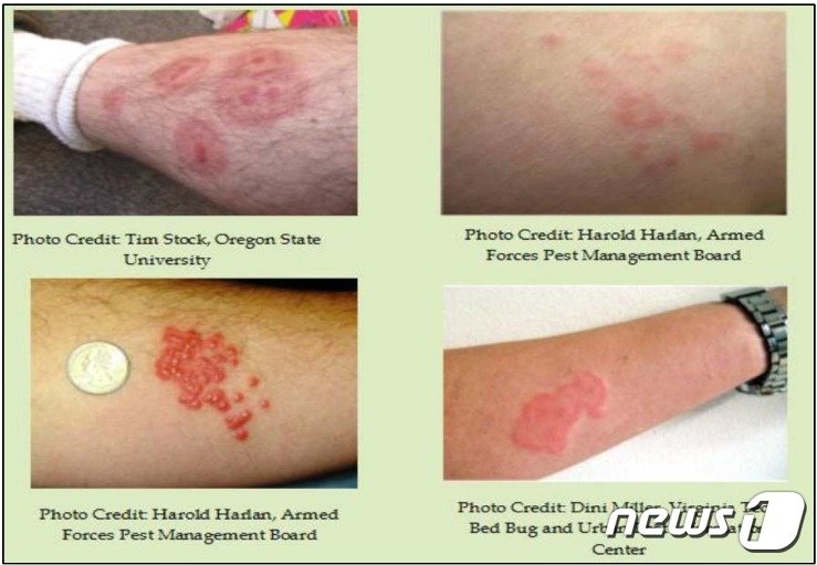 본문 이미지 - 빈대 물림으로 인해 발생한 피부 발진 사례/ⓒ News1 (질병관리청 제공)