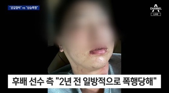 임혜동은 김하성에게 상습 폭행을 당했다며 증거 사진을 공개하기도 했으나, 이는 임혜동이 과거 가정 폭력을 당했을 때 찍은 사진이라는 의혹이 제기됐다. &#40;채널A 갈무리&#41;
