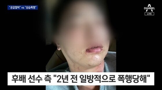 본문 이미지 - 임혜동은 김하성에게 상습 폭행을 당했다며 증거 사진을 공개하기도 했으나, 이는 임혜동이 과거 가정 폭력을 당했을 때 찍은 사진이라는 의혹이 제기됐다. (채널A 갈무리)