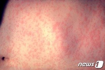 본문 이미지 - 홍역 발진. (질병청 제공)