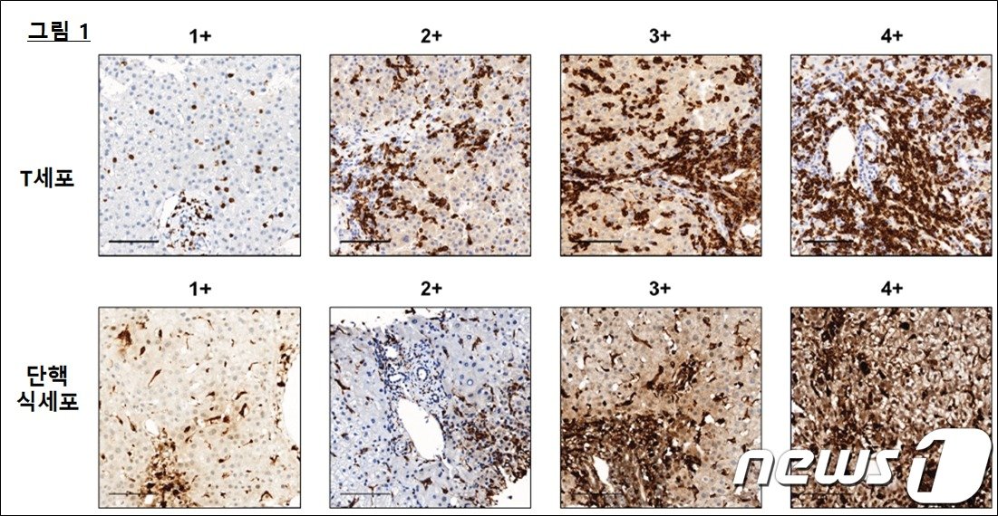독성 간염 환자의 간에서 관찰되는 T세포 및 단핵 식세포의 다양한 침윤 모습. 1~4단계로 나뉘며 4단계로 갈수록 침윤의 정도가 심해진다/은평성모병원 제공