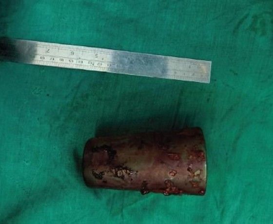 결장절개술로 남성의 몸속에서 꺼낸 12㎝ 길이의 유리컵. (네팔 의학협회 저널)