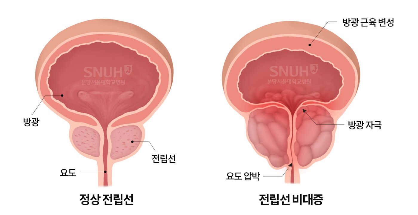본문 이미지 - (분당서울대병원 제공)