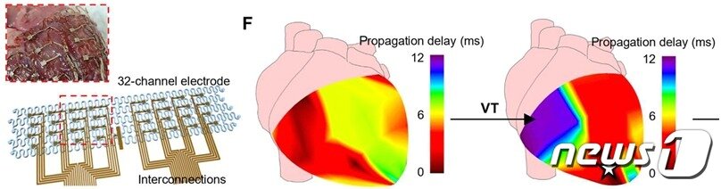 본문 이미지 - 다채널 전극 어레이와 이의 부정맥 진단 능력 검증. (왼쪽) 8&times;4다채널 전기 자극 어레이의 모습. (가운데, 오른쪽) 32개 전극 채널로 심실 전기 신호를 측정하고 매핑한 결과, 심실빈맥 증상 발생 시 전기 신호를 바탕으로 부정맥이 시작되는 부위(흰색 별)를 확인하고 부정맥이 어떻게 전파되는지 알 수 있었다/서울대학교병원 제공
