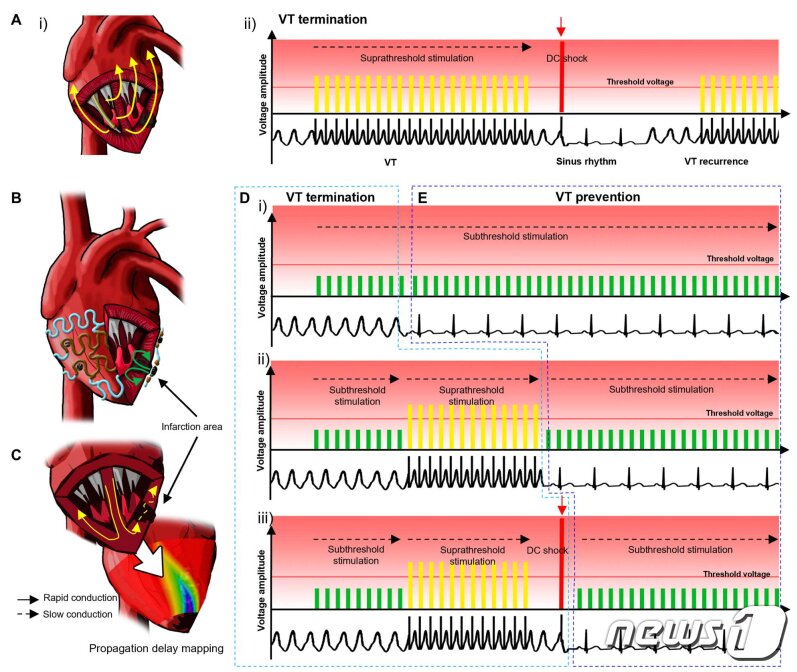 본문 이미지 - 다채널 전극 어레이의 부정맥 차단 과정. 악성 부정맥인 심실빈맥 발생시 ⅰ) 역치하 전기 자극(녹색 세로선)을 통해 부정맥을 멈추게 함. ⅱ), ⅲ) 역치하 전기 자극의 효과가 없을 경우 역치보다 높은 전기 자극(노란색 세로선) 또는 제세동(빨간색 세로선)을 통해 부정맥을 멈추게 함/서울대학교병원 제공