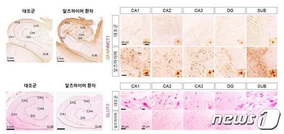 알츠하이머 환자 뇌조직의 MCT1 및 GLUT3 변화. (기초과학연구원 제공) /뉴스1