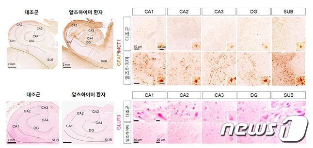 본문 이미지 - 알츠하이머 환자 뇌조직의 MCT1 및 GLUT3 변화. (기초과학연구원 제공) /뉴스1