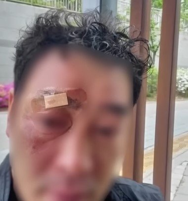 본문 이미지 - 입주민이 쏜 가스총에 맞아 전치 2주의 상해를 입은 관리사무소 직원. 총구가 조금만 아래로 향했다면 실명 위기에 처할 수도 있었다. (JTBC '사건반장')