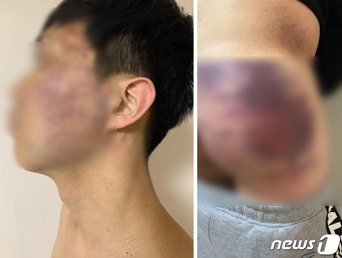 본문 이미지 - 김씨 일당에게 납치·폭행당해 피멍이 든 피해자 A씨 지인의 얼굴과 엉덩이.  (서울경찰청 강력범죄수사대 제공) ⓒ뉴스1
