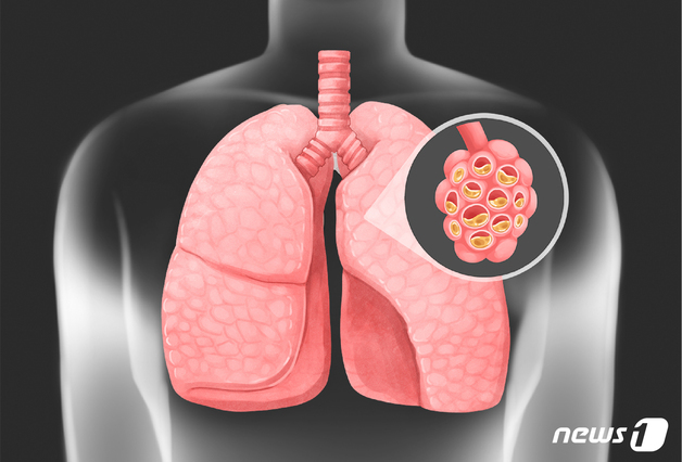 [100세건강]"기침 오래간다 했더니"…스펀지 같던 폐가 굳는 '이 병'