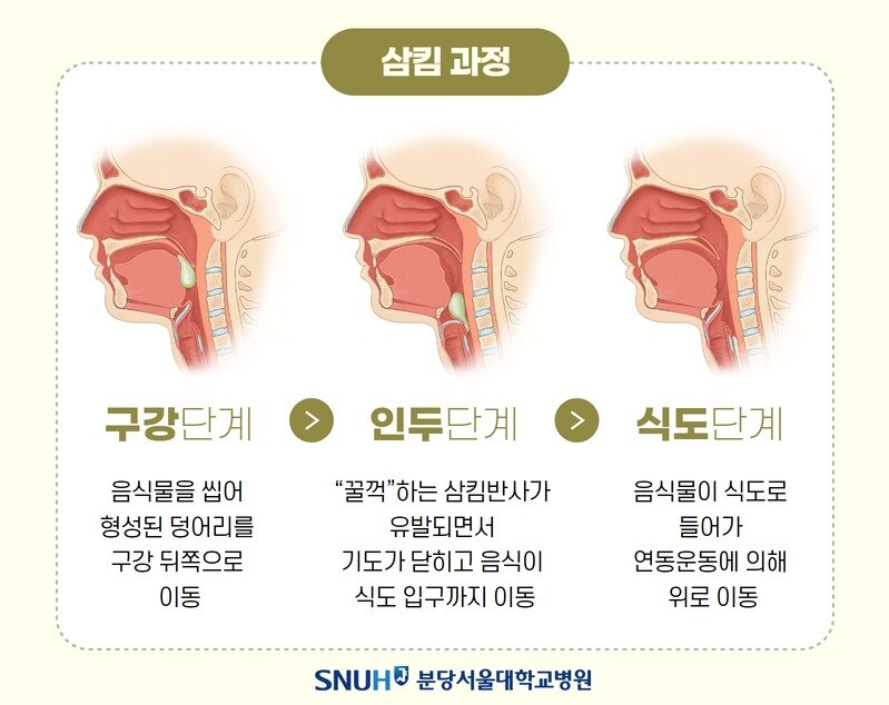 본문 이미지 - (분당서울대병원 제공)