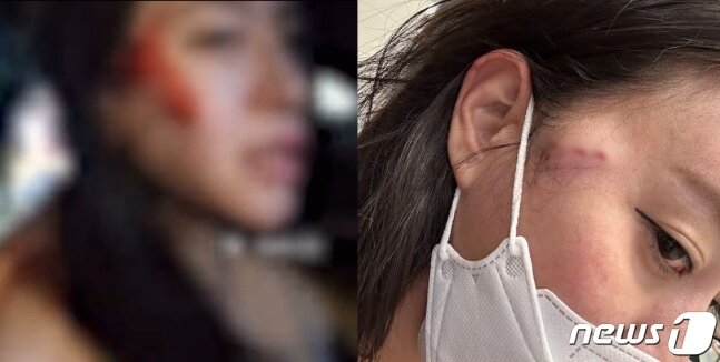 본문 이미지 - BJ 냠냠짱짱에게 폭행을 당한 BJ 감성여울이 자신의 얼굴에 생긴 포크 자국 상처를 공개했다. (온라인 커뮤니티 갈무리)