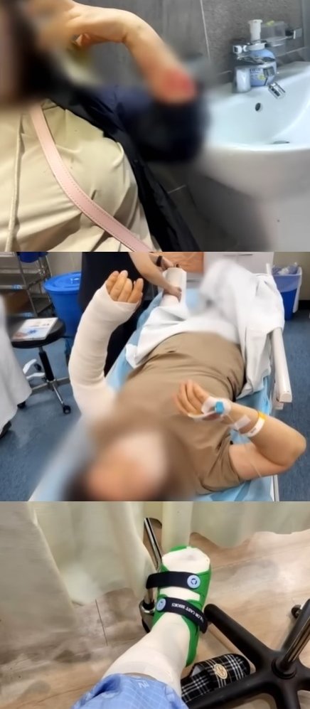 본문 이미지 - 전치 12주의 부상을 입은 A씨. (JTBC)