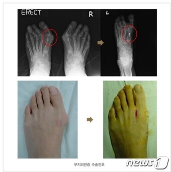 본문 이미지 - 무지외반증 수술 전후 비교 모습&#40;해운대부민병원 제공&#41;