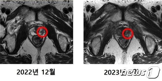 중입자 치료를 받은 최 모 씨(64)의 MRI 촬영 사진. 기존에 발견됐던 암 조직(왼쪽 사진 표시)이 치료 후에는 발견되지 않았다. (연세암병원 제공)