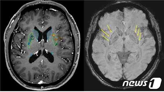 뇌이식 전(왼쪽)과 후 MRI. 이식 후 MRI에서 성공적으로 세포가 이식된 부위(화살표)를 확인할 수 있다. (세브란스병원 제공)