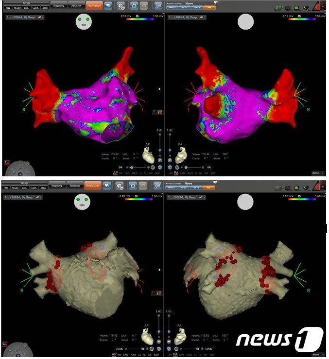 &#40;위&#41; 고주파 전극도자 절제술을 받기 전 환자의 심장 모습. &#40;아래&#41; 고주파로 하나하나 점을 찍어 심방세동 신호를 없앤 모습. &#40;김동혁 교수 제공&#41;