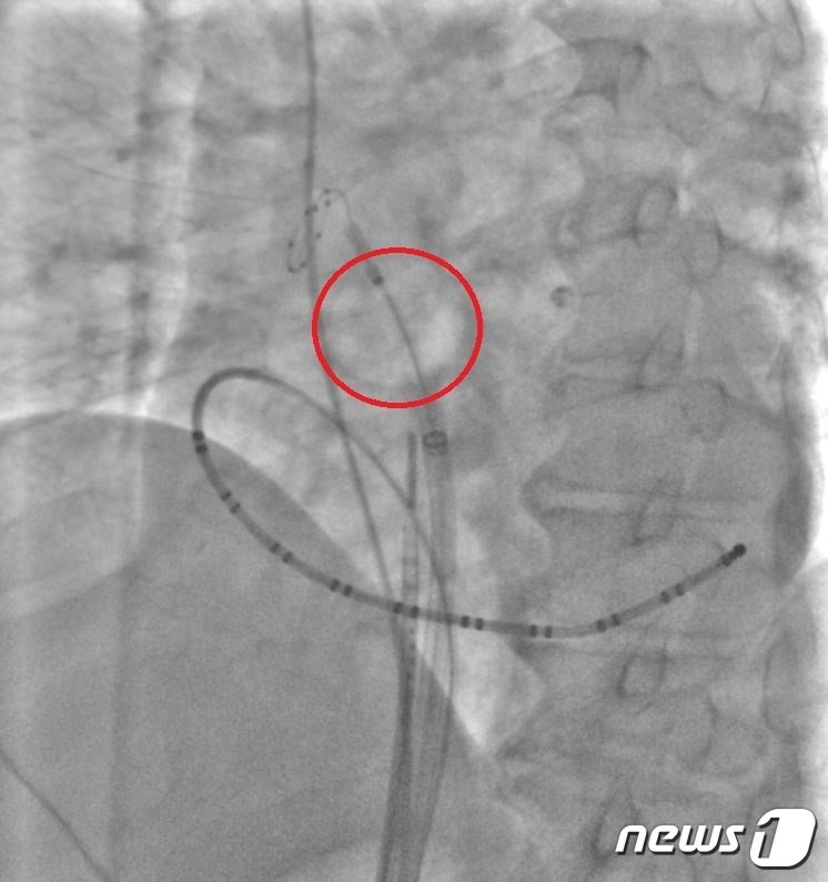 냉각 풍선 전극 도자 절제술&#40;Cryoablation&#41;을 받은 후 심장의 모습. 빨간 원이 냉각풍선 시술 부위. &#40;김동혁 교수 제공&#41;