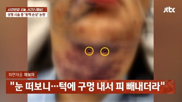 강남 성형외과서 지방흡입술 하다 턱 뚫렸다…진료기록에 '동맥 손상 출혈'