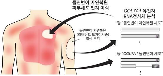 '가벼운 마찰에도 상처·수포' 희귀질환…국내의료진, 치료법 찾았다