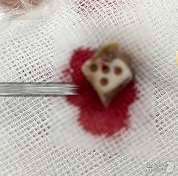 본문 이미지 - 수술로 제거한 주사위. 일부가 부식돼 있다 - 웨이보 갈무리