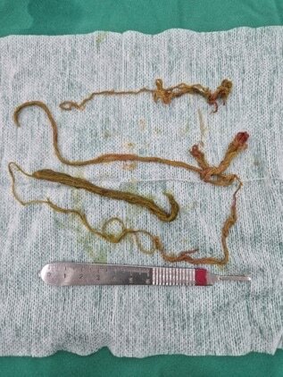 본문 이미지 - 개복 수술로 제거한 실 (본동물의료센터 제공) ⓒ 뉴스1