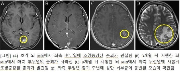 "뇌종양인 줄 알았는데 기생충"…국내 의료진, 제거 수술 성공