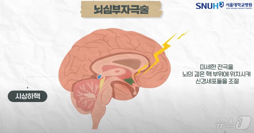 뇌 심부자극술&#40;서울대학교병원 제공&#41;