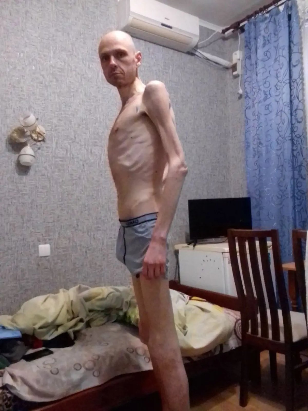 우크라이나 군인 출신의 볼로디미르 체마-부르소프(41)가 러시아군에 포로로 잡혀갔다 석방된 후의 모습. <출처=뉴욕포스트 기사 캡처>