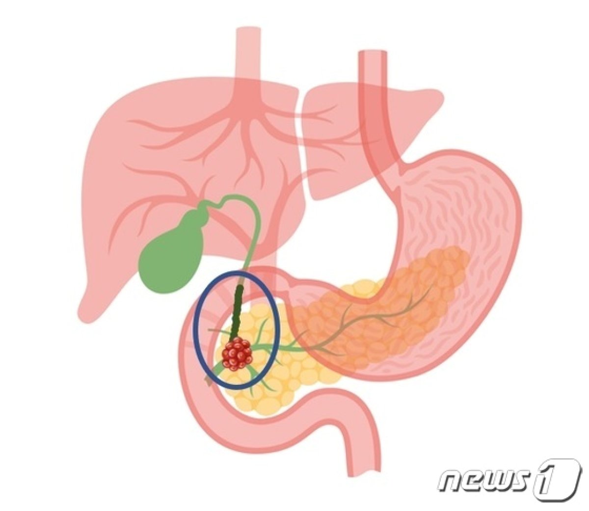 췌장에 생긴 종양이 담관을 막아 담즙이 정체된 모습. (한림대동탄성심병원 제공)