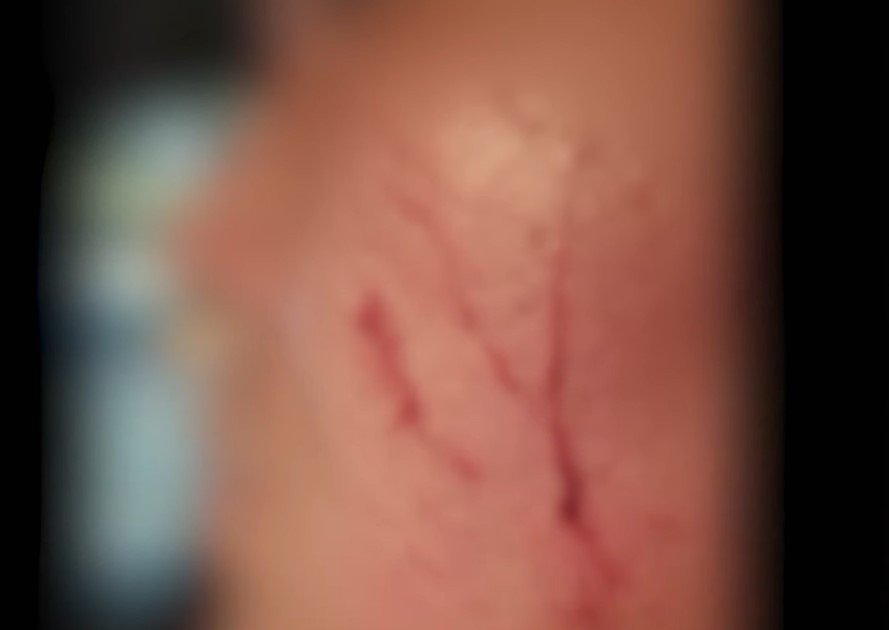 본문 이미지 - A 씨에게 맞고 쥐어뜯겨 피가 난 택시 기사의 뺨. (SBS 갈무리)