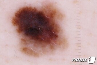 본문 이미지 - 흑색종의 모습. 작은 눈금하나가 0.5mm로 이 흑색종의 크기는 8~9mm 정도다. (이갑석 교수 제공)