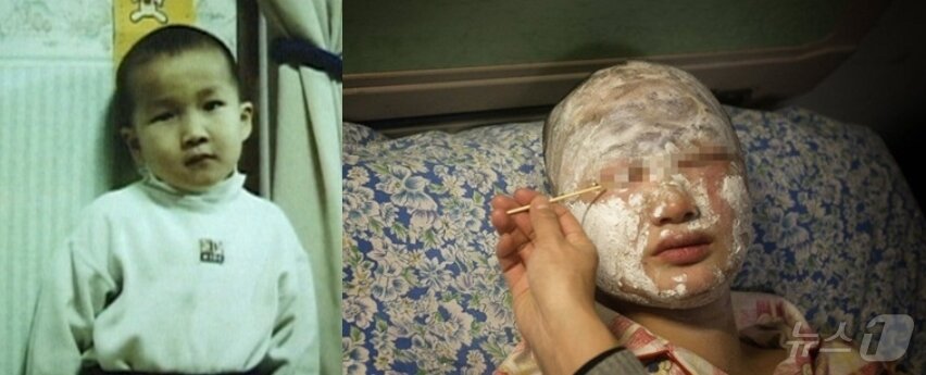 본문 이미지 - 천진난만한 밝은 모습의 김태완 군과 황산테러로 인해 얼굴 전체 등 화상을 입고 치료를 받고 있는 모습. (KBS 갈무리) ⓒ 뉴스1 