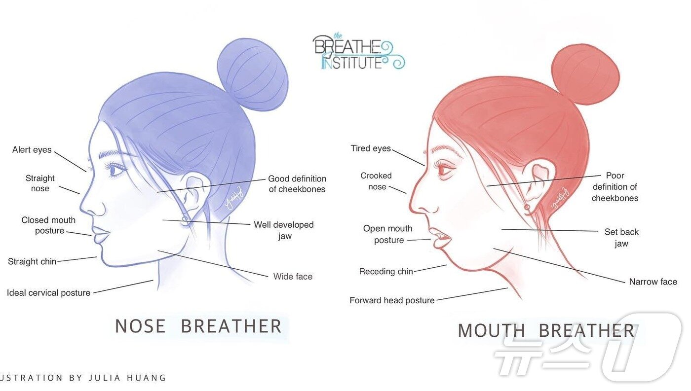 본문 이미지 - 코로 숨을 쉬는 사람의 얼굴형(왼쪽)과 입으로 숨을 쉬는 사람의 얼굴형(청담 본큐어한의원 제공)