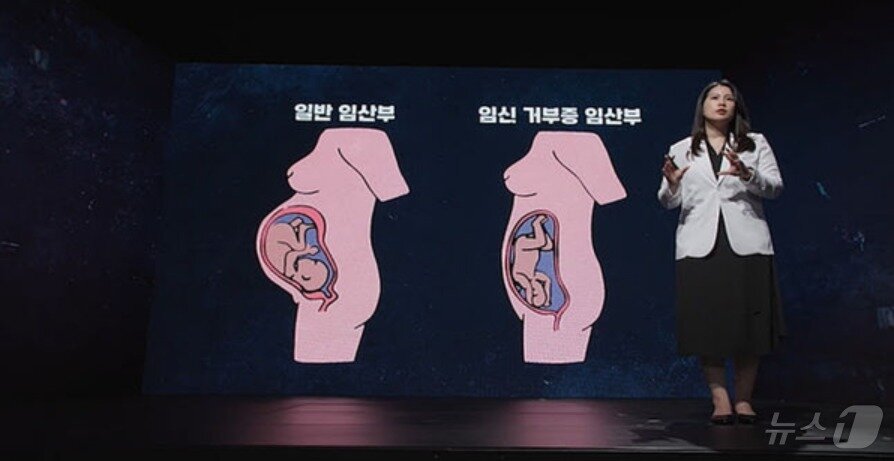 본문 이미지 - 임신 거부증을 앓을 경우 자궁 발달 상태가 달라지는 등 임신 상태를 알아채지 못할 가능성이 높은 것으로 알려졌다. (KBS 갈무리) ⓒ 뉴스1 