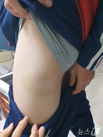 본문 이미지 - 피해 아동 측에서 사건 발생 후 촬영한 멍자국.(피해 아동 측 제공)/뉴스1