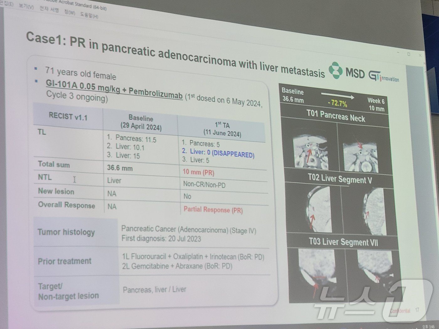 지아이이노베이션이 개발 중인 면역항암제 &#39;GI-101A&#39;와 &#39;키트루다&#39;&#40;성분명 펨브롤리주맙&#41;를 췌장암 환자에게 병용 투약한 결과. 2024. 7. 17/뉴스1 ⓒ News1 황진중 기자