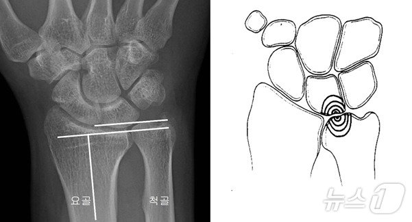 본문 이미지 - 좌측의 그림처럼 손목에서 척골의 길이가 요골보다 긴 경우, 우측의 그림처럼 척골과 수근골 사이에 충돌이 일어나는 상태를 ‘척골충돌증후군’이라고 한다(중앙대학교병원 제공)